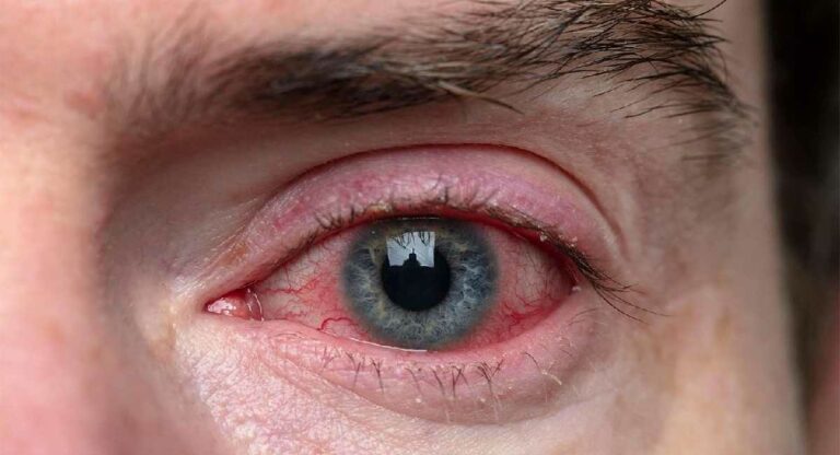 Conjunctivitis : डोळे आलेत का…? अशी घ्या काळजी