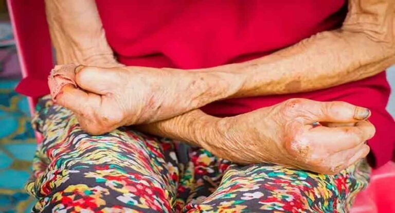 Leprosy Patient : मुंबईत कुष्ठरोग वाढतोय!