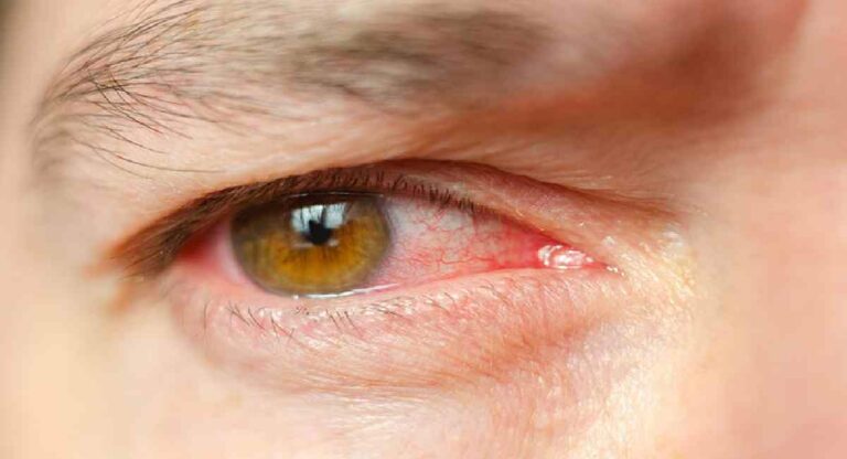 Conjunctivitis : यंदाच्या वर्षांत राज्यात ३ लाख ५७ हजार २६५ डोळ्यांचे रुग्ण