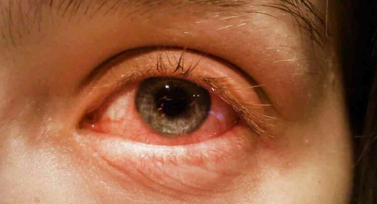 Conjunctivitis Patient : राज्यात डोळ्यांच्या साथीमुळे रुग्णांची संख्या पाच लाखांपर्यंत