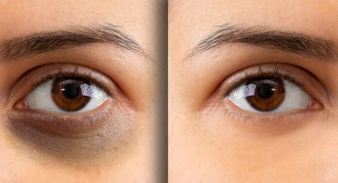Beauty Tips: डोळ्याखालच्या काळ्या वर्तुळावर करा 'हे' घरगुती उपाय, त्वचा उजळायलाही होईल मदत